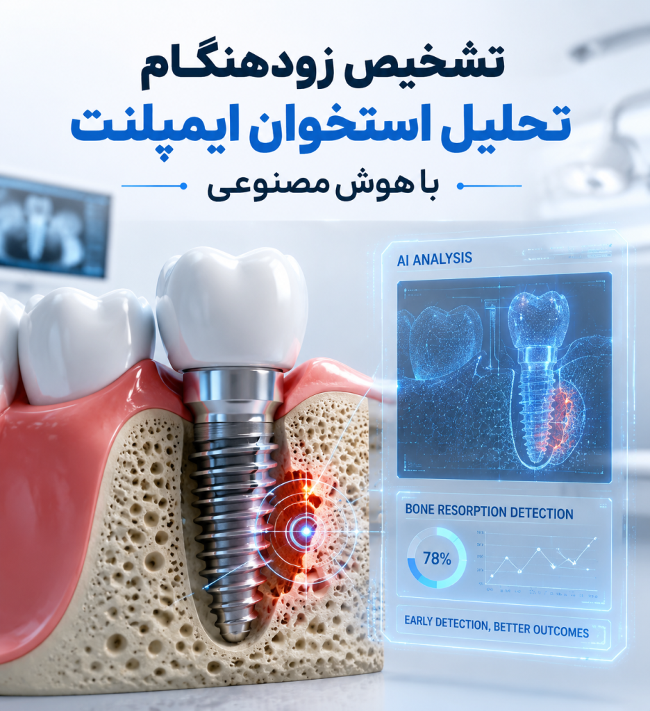 ایمپلنت ؛ تشخیص زودهنگام تحلیل استخوان